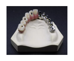 Malo Bridge Implant Restoration for Full Arch Replacement