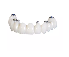 Screw-Retained Implant Crowns for Reliable Restoration