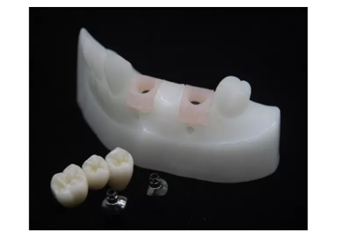Custom Implant Abutments for Precise Restorative Results