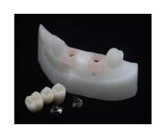 Custom Implant Abutments for Precise Restorative Results