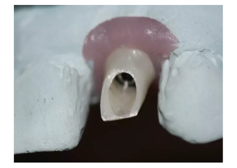 Custom Implant Abutments for Precise Restorative Results - 2/2