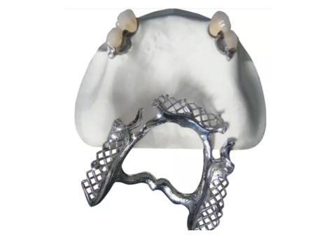 Ball Attachment Systems for Secure Implant Overdentures