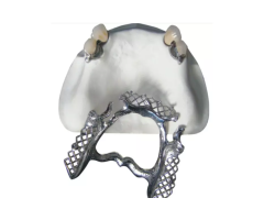 Ball Attachment Systems for Secure Implant Overdentures