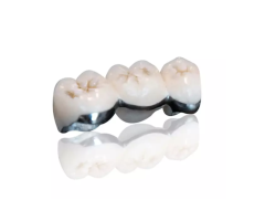 Porcelain-Fused-to-Metal Crowns for Strength & Esthetics