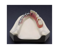Custom Implant Bar Attachments for Stable Overdentures