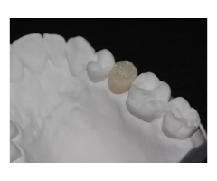 IPS E.max Veneers & Crowns for Natural-Looking Restorations